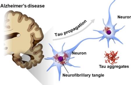 Nghiên cứu mới về bệnh lý của Alzheimer