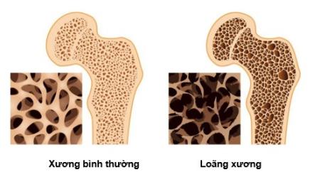 Bệnh loãng xương & Những điều cần biết