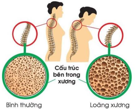 Nguy cơ loãng xương  ở bệnh nhân điều trị ung thư vú