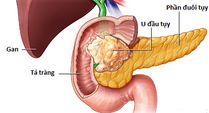 Vi khuẩn đường ruột liên quan đến ức chế miễn dịch trong ung thư tuyến tụy