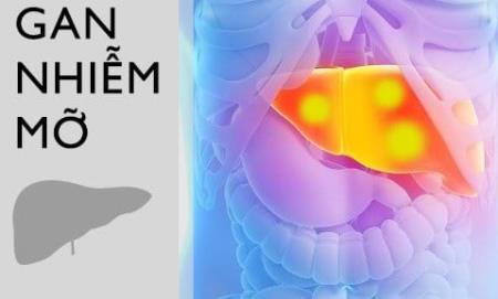 Một nghiên cứu mới liên quan đến việc tiêu thụ fructose lỏng với bệnh gan nhiễm mỡ