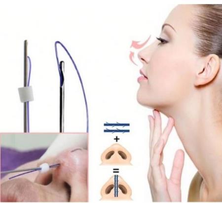 Nâng mũi nghĩa là gì? Có các loại nâng mũi phổ biến nào hiện nay