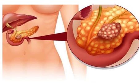 Thử nghiệm hương pháp điều trị ung thư tuyến tụy thông qua các mô hình bản sao tuyến tụy organoids