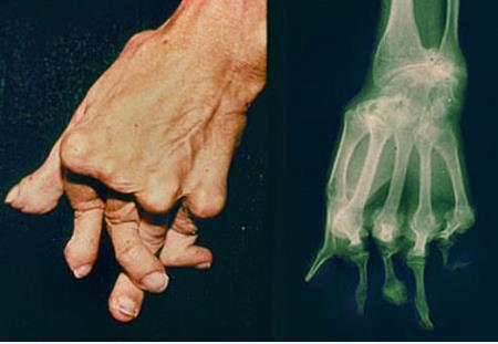 Viêm khớp vảy nến – trị kịp thời, ngăn tàn phế