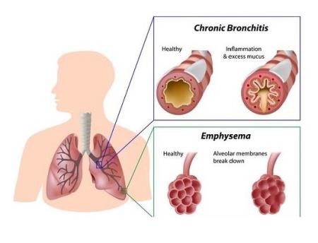Chất truyền tin interleukin-3 có thể làm giảm các triệu chứng hen suyễn?