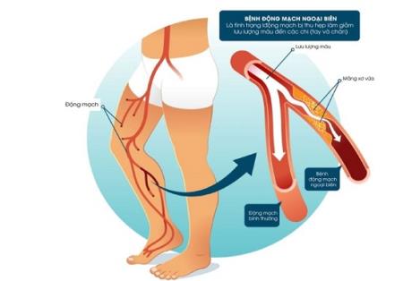 Đau cách hồi – dấu hiệu của các bệnh lý tim mạch nguy hiểm