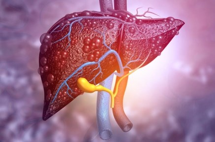 Liệu pháp miễn dịch kết hợp hiệu quả cho bệnh ung thư gan