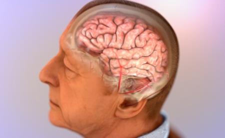 Phát hiện ra nhân tố trong sự tiến triển bệnh Alzheimer