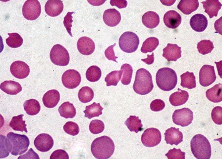 Các nhà nghiên cứu phát hiện ra các hợp chất tiêu diệt bệnh bạch cầu mới