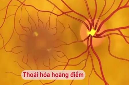 Tìm thấy các nguyên nhân gây bệnh thoái hóa điểm vàng do tuổi tác