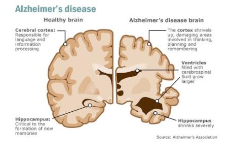Các vi rút thông thường có thể kích hoạt sự khởi phát của bệnh Alzheimer