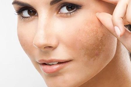 Điểm danh những loại thực phẩm ngăn ngừa bị nám da hiệu quả nhất