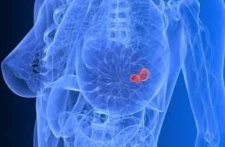 Collagen đóng vai trò quan trọng trong việc di căn ung thư vú