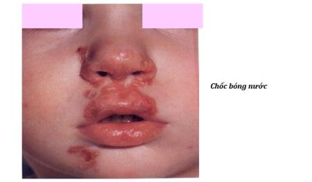 Bệnh chốc lở ngoài da ở trẻ em