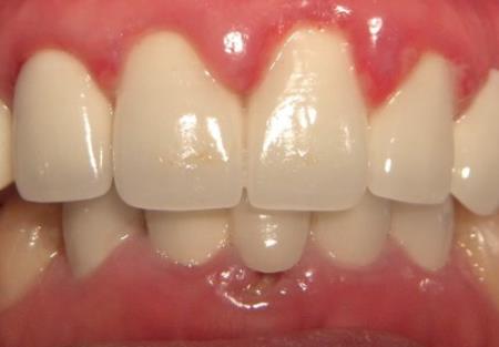 Chuỗi thức ăn vi sinh: Tương tác dinh dưỡng thúc đẩy viêm nha chu