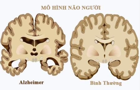 Protein có thể giúp đánh bại bệnh Alzheimer và tăng tuổi thọ