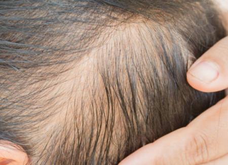 Phát hiện mới về rụng tóc ở nam giới