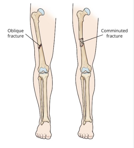 CBD và CBG có thể thúc đẩy quá trình lành xương gãy, kiểm soát cơn đau