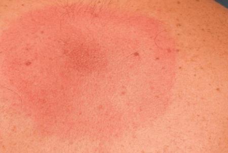 Phương pháp kháng sinh mới chứng tỏ có triển vọng chống lại vi khuẩn lyme