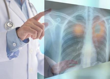 Một loại thuốc dị ứng có thể giúp điều trị ung thư phổi