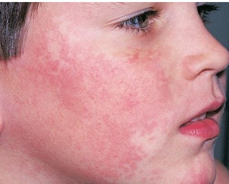 Mục tiêu điều trị mới tiềm năng cho các bệnh viêm nhiễm như lupus và nhiễm trùng huyết