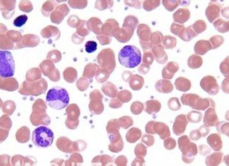 Phát hiện bất ngờ cho thấy bạch cầu trung tính có thể là vũ khí chống ung thư chính