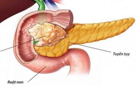 Thiết bị cấy ghép thu nhỏ khối u tuyến tụy