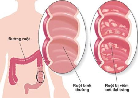 Nghiên cứu làm sáng tỏ cách bệnh viêm ruột phát triển
