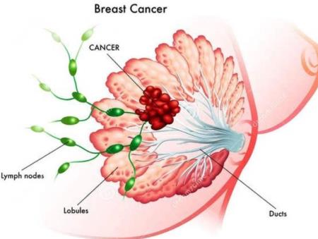 Các nhà khoa học đưa ra khám phá đầy hứa hẹn trong cuộc chiến chống ung thư vú