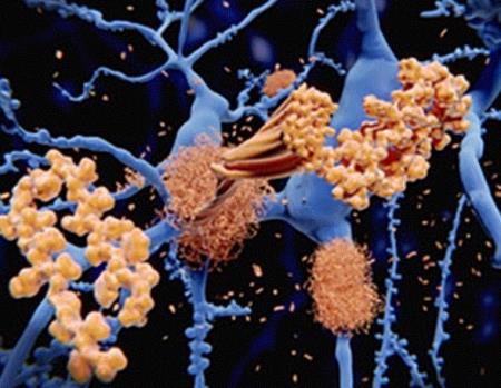 Các tế bào miễn dịch góp phần gây ra bệnh Alzheimer