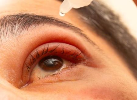 Thuốc nhỏ mắt Xdemvy để điều trị viêm bờ mi do Demodex