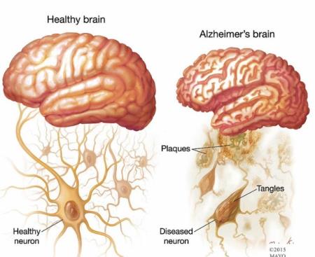 Tái tạo năng lượng cho ty thể để điều trị bệnh Alzheimer