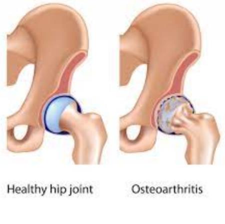 Chất đánh dấu PET mới phát hiện viêm khớp trước khi các triệu chứng xuất hiện