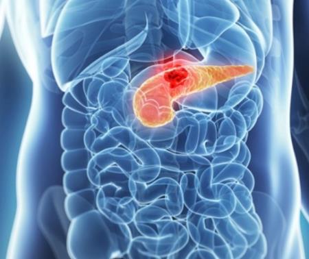 Hướng mới điều trị ung thư tụy