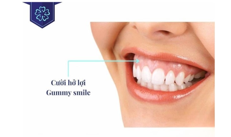 Những loại thuốc cần sử dụng sau khi điều trị cười hở lợi