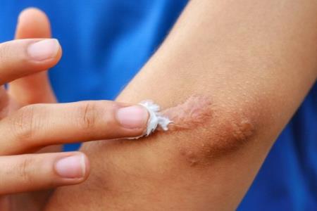 Gel điều trị vết thương chống lại tình trạng kháng kháng sinh