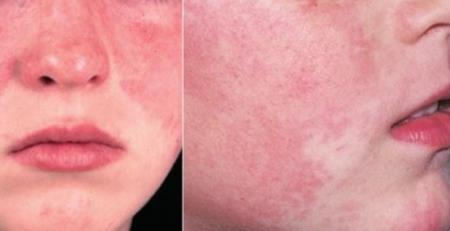 Theo dõi nguyên nhân di truyền của bệnh lupus để cá nhân hóa việc điều trị