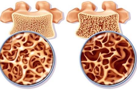 AI có thể cho bạn biết bạn có nguy cơ bị loãng xương không?