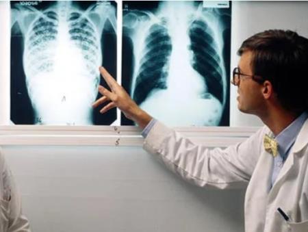 Những chủng bệnh lao nào có khả năng lây nhiễm cao nhất?