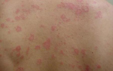 Thuốc Pyzchiva  trị vảy nến mảng bám