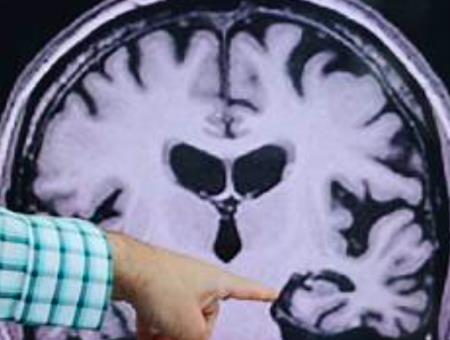 Xét nghiệm bệnh Alzheimer bằng phương pháp phân tích mới