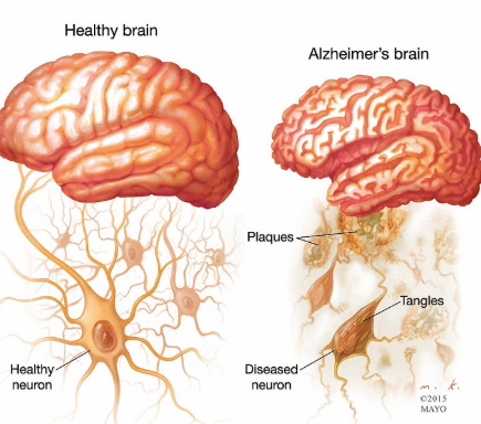 Tăng protein 'CLU' thúc đẩy khả năng phục hồi của não và có thể bảo vệ khỏi bệnh Alzheimer
