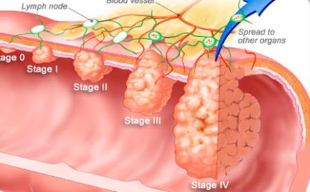 Thiếu oxy thúc đẩy sự phát triển của ung thư ruột kết