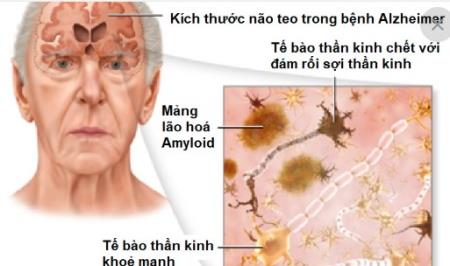 Tại sao bệnh Alzheimer lại tấn công vào trung tâm trí nhớ của não trước tiên