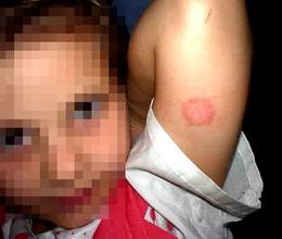 Nấm da và thuốc điều trị