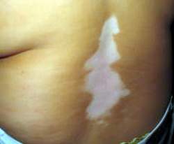 Một số thuốc điều trị bệnh bạch biến