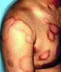 Sử dụng fluconazol trị nấm - Thận trọng cần thiết