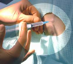 Độc tính của thuốc gây tê tại chỗ