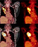 Điều trị u lành tuyến tiền liệt bằng laser