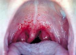 Thuốc dùng khi viêm họng do liên cầu khuẩn tán huyết A